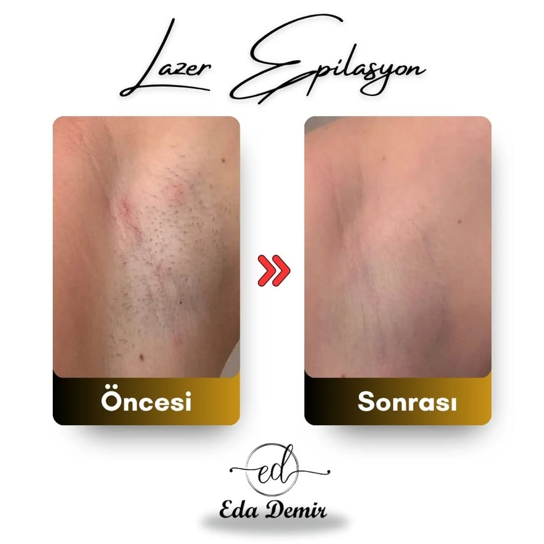 Post 8 by Eda Demir Beauty Center Tekirdağ 🏅 on Instagram (image)