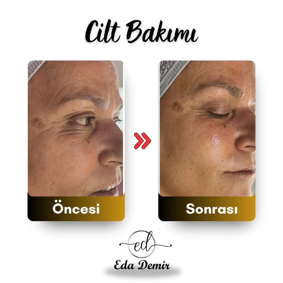 Post 9 by Eda Demir Beauty Center Tekirdağ 🏅 on Instagram (image)