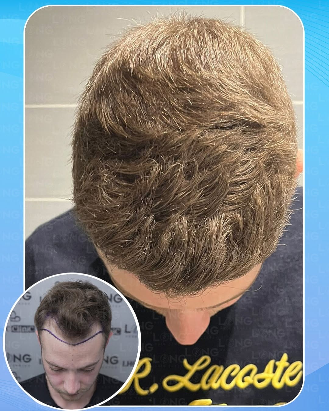 Post 4 by LongHairCenter|HairTransplant | Dental on Instagram (carousel)