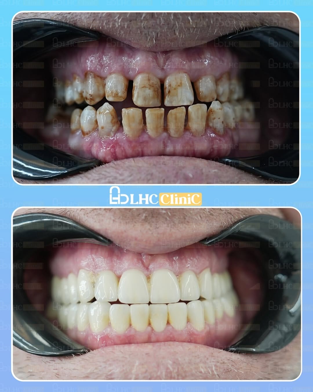 Post 3 by LongHairCenter|HairTransplant | Dental on Instagram (carousel)