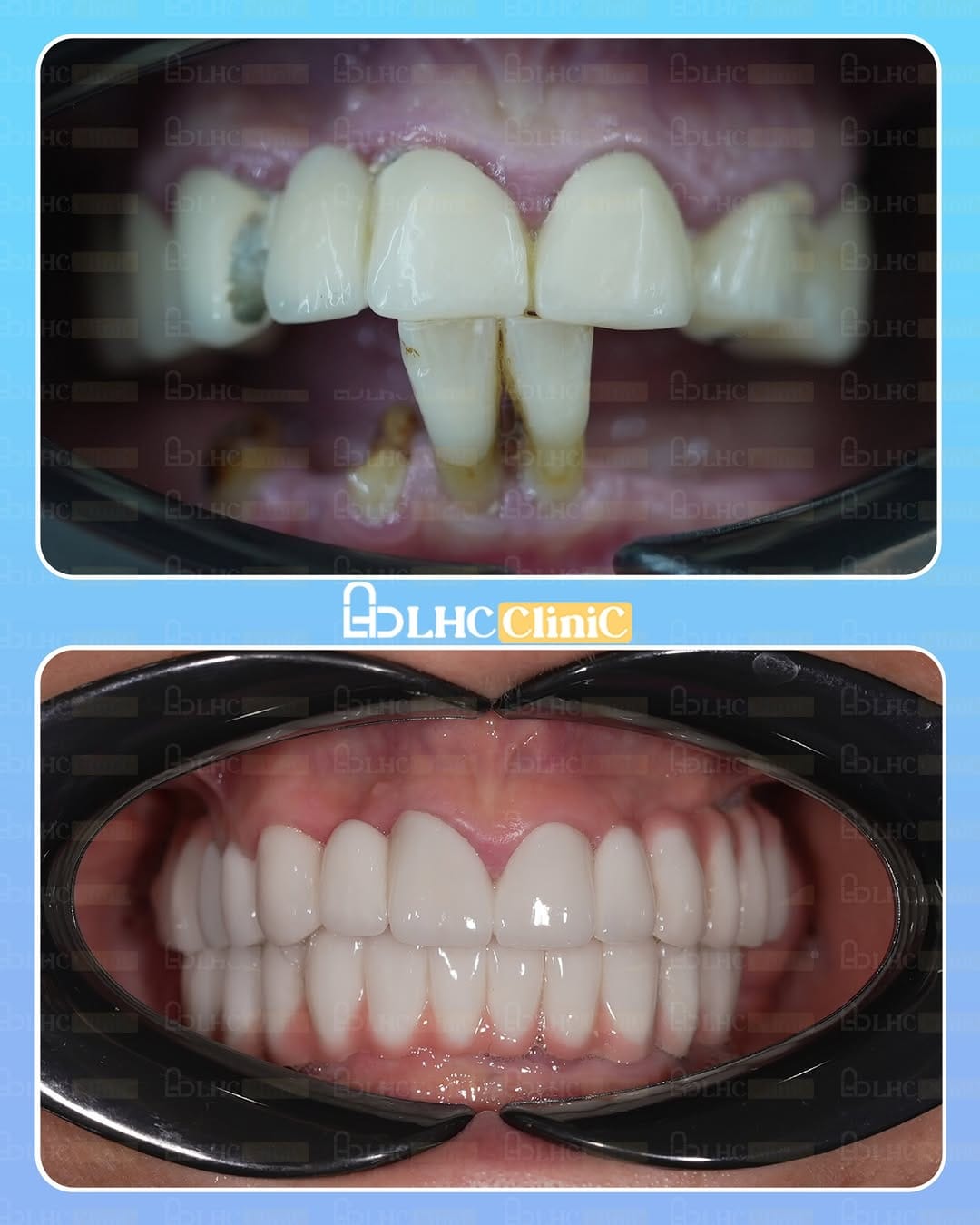 Post 6 by LongHairCenter|HairTransplant | Dental on Instagram (image)