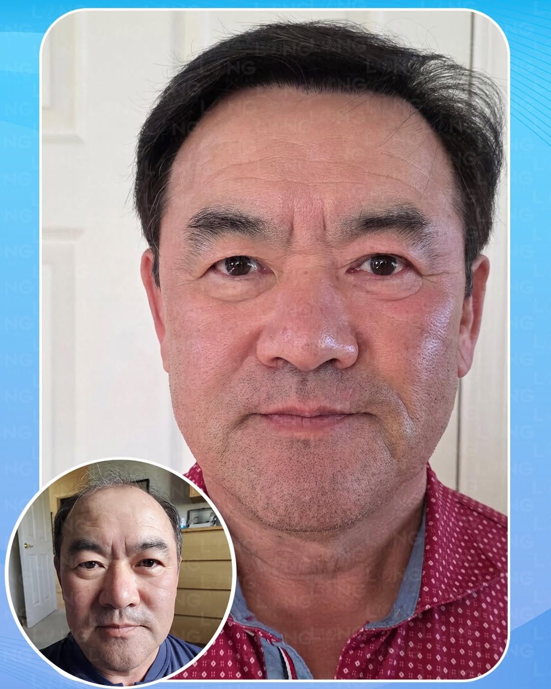 Post 7 by LongHairCenter|HairTransplant | Dental on Instagram (carousel)