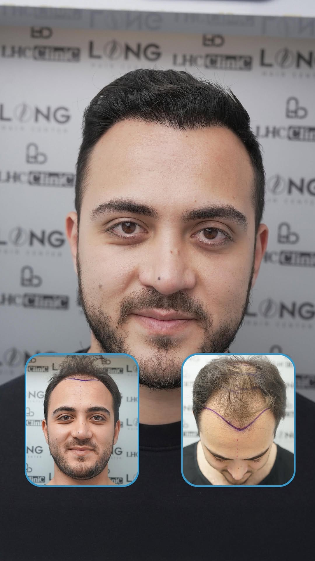 Post 8 by LongHairCenter|HairTransplant | Dental on Instagram (video)
