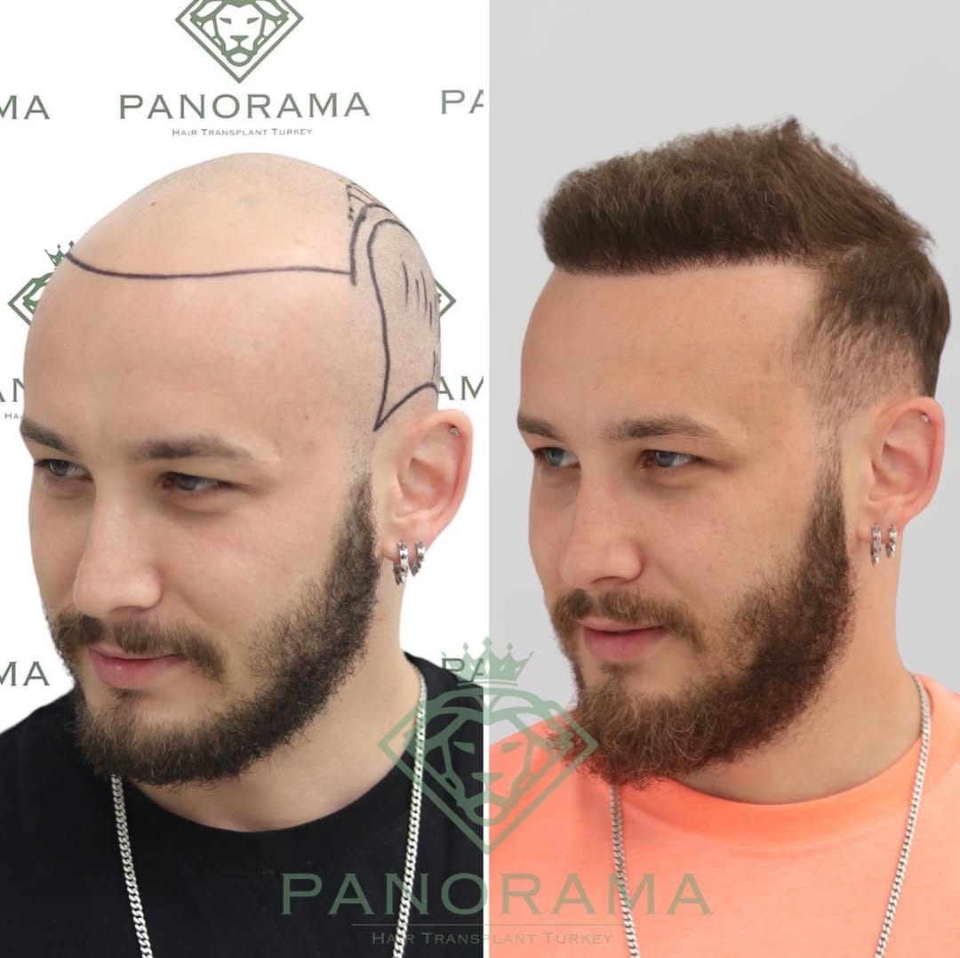 Post 10 by Panorama Hair Turkey on Instagram (carousel)