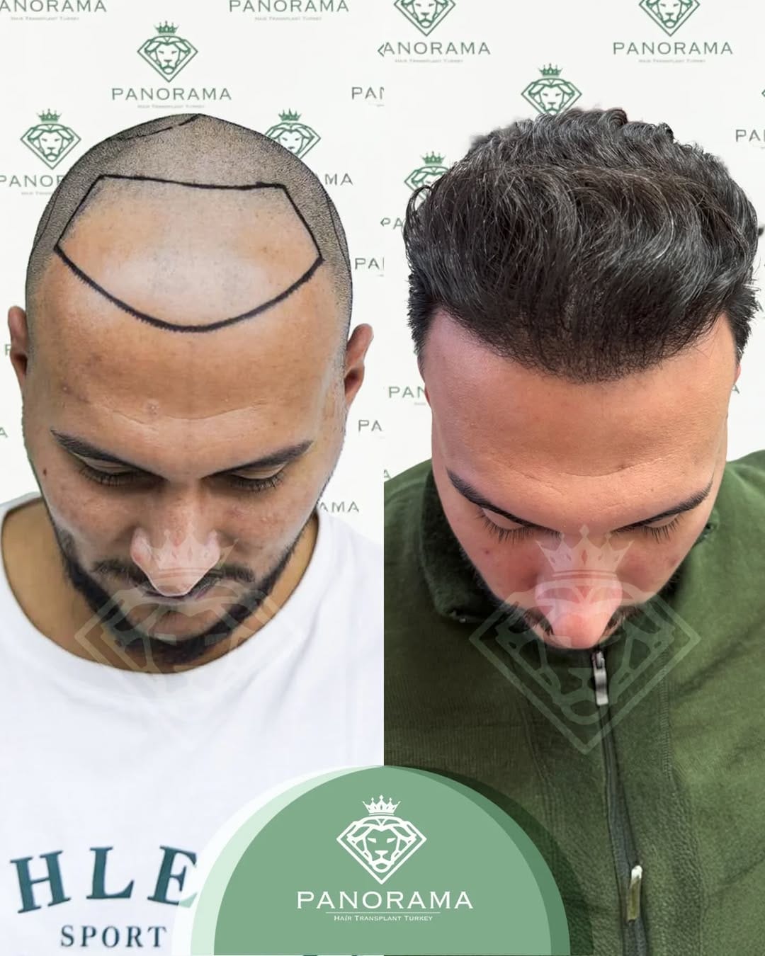 Post 3 by Panorama Hair Turkey on Instagram (carousel)