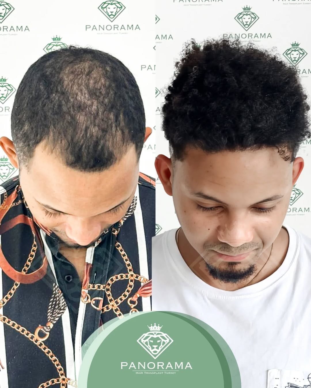Post 6 by Panorama Hair Turkey on Instagram (carousel)