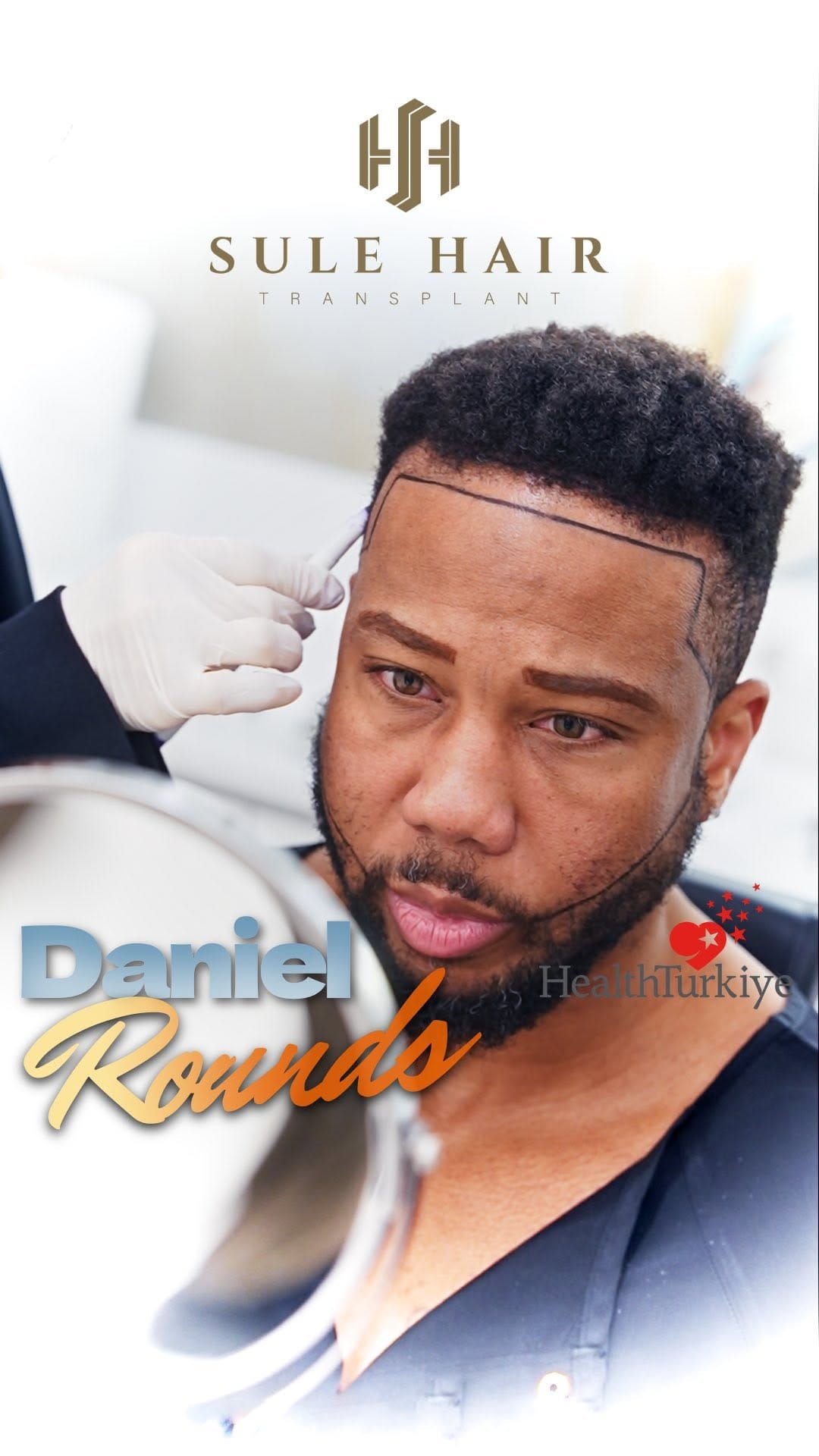 Post 8 by Sule Hair Transplant on Instagram (video)
