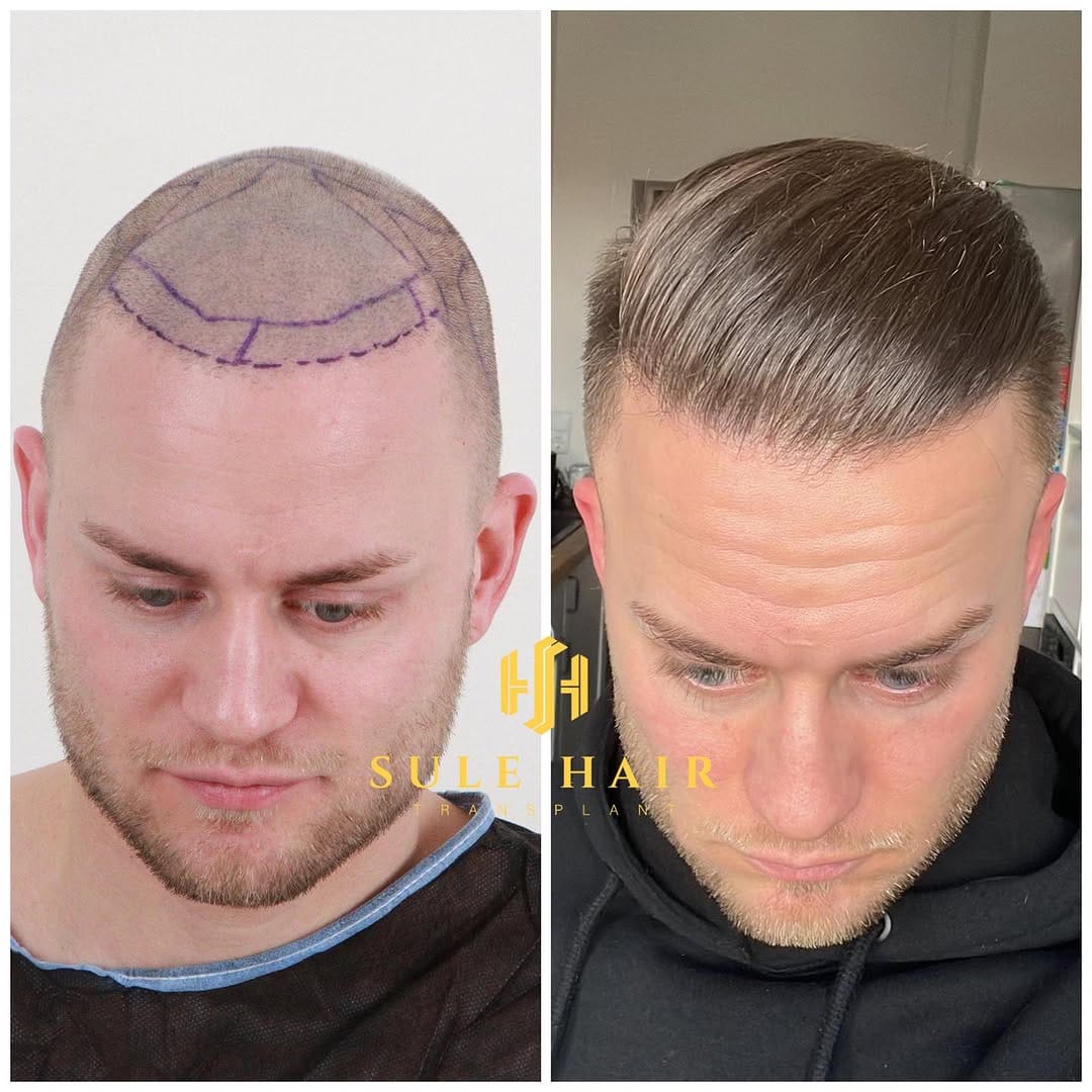 Post 10 by Sule Hair Transplant on Instagram (carousel)
