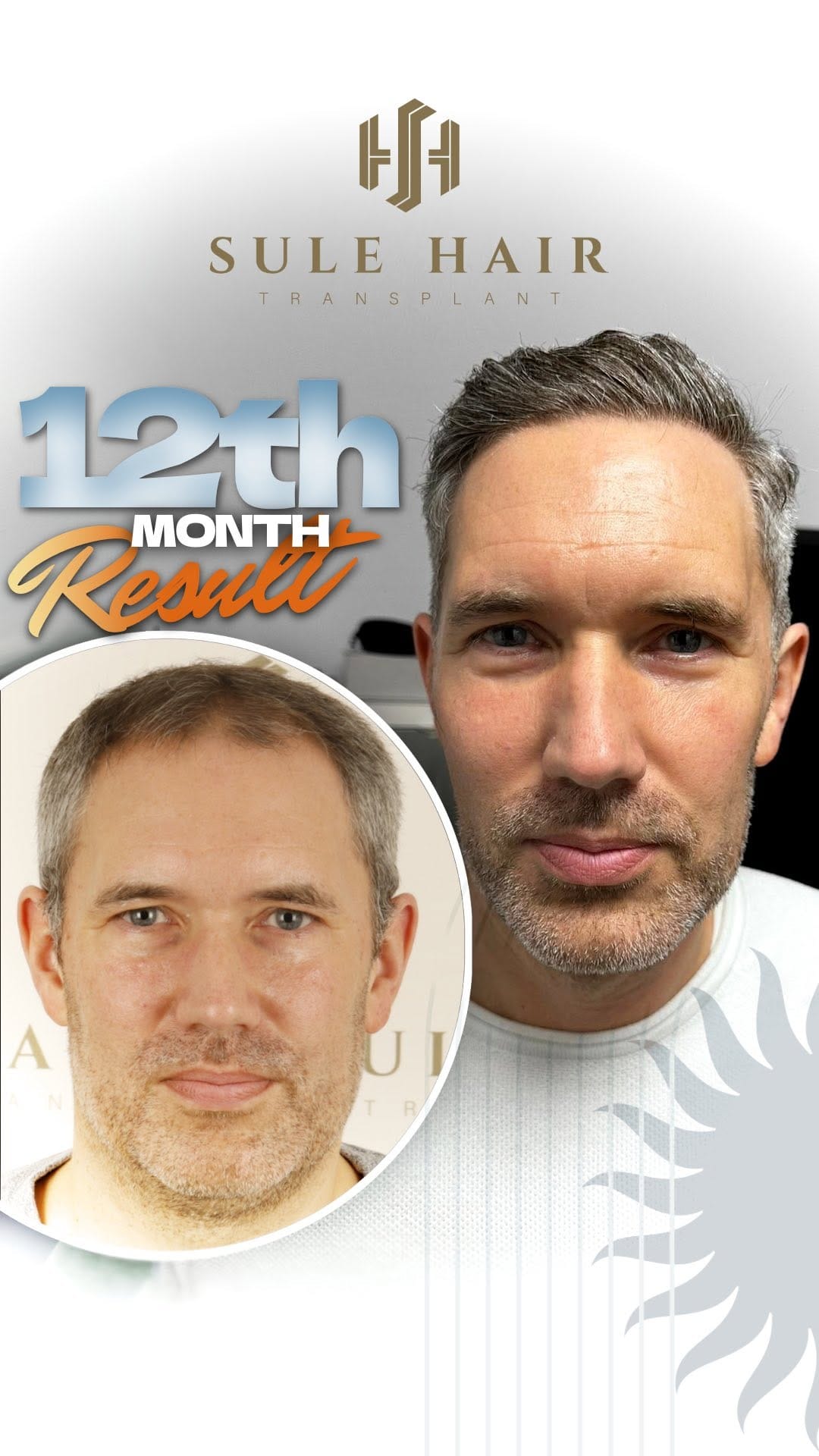 Post 6 by Sule Hair Transplant on Instagram (video)