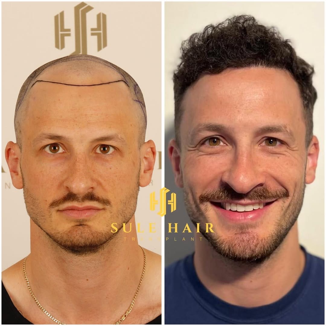 Post 4 by Sule Hair Transplant on Instagram (carousel)