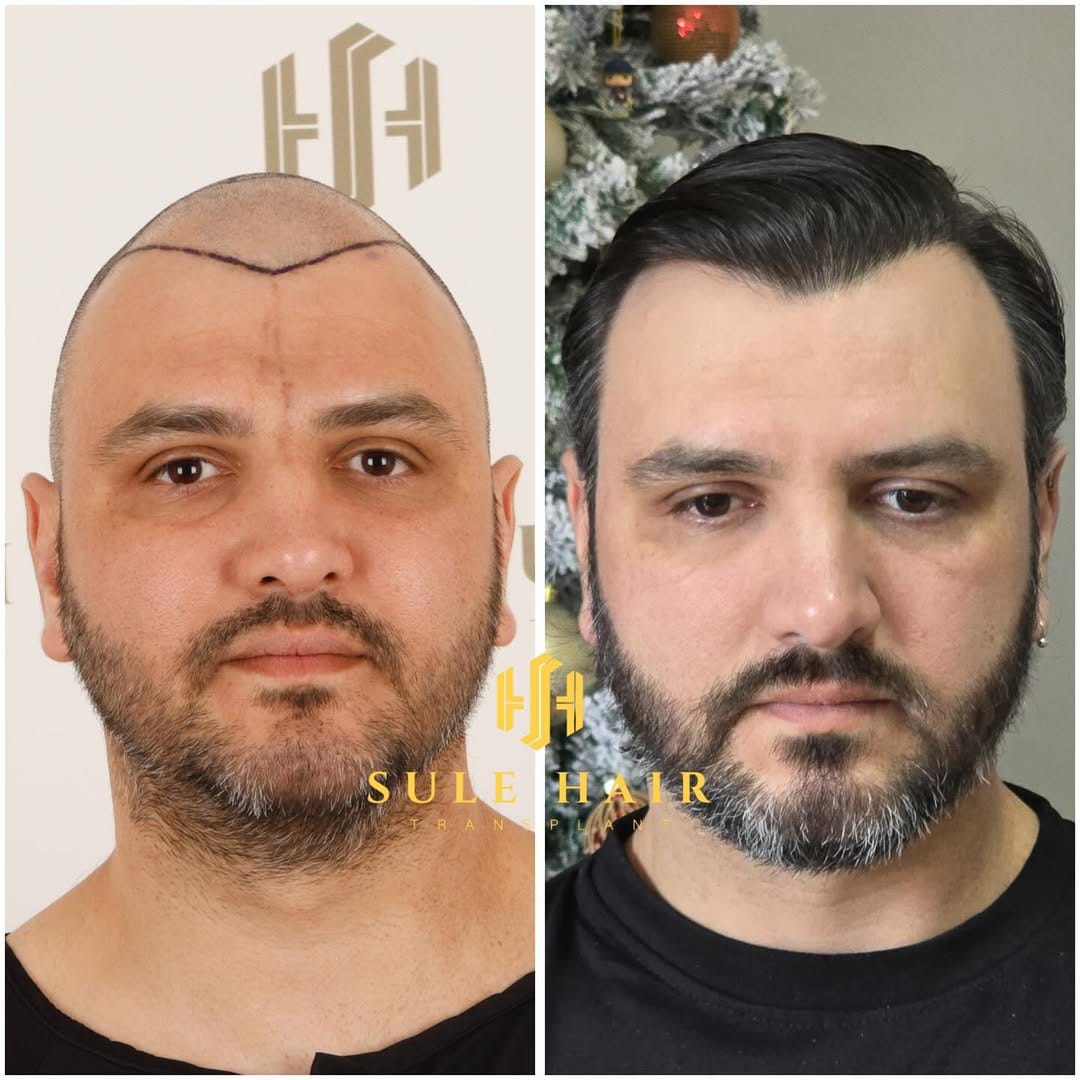 Post 7 by Sule Hair Transplant on Instagram (carousel)