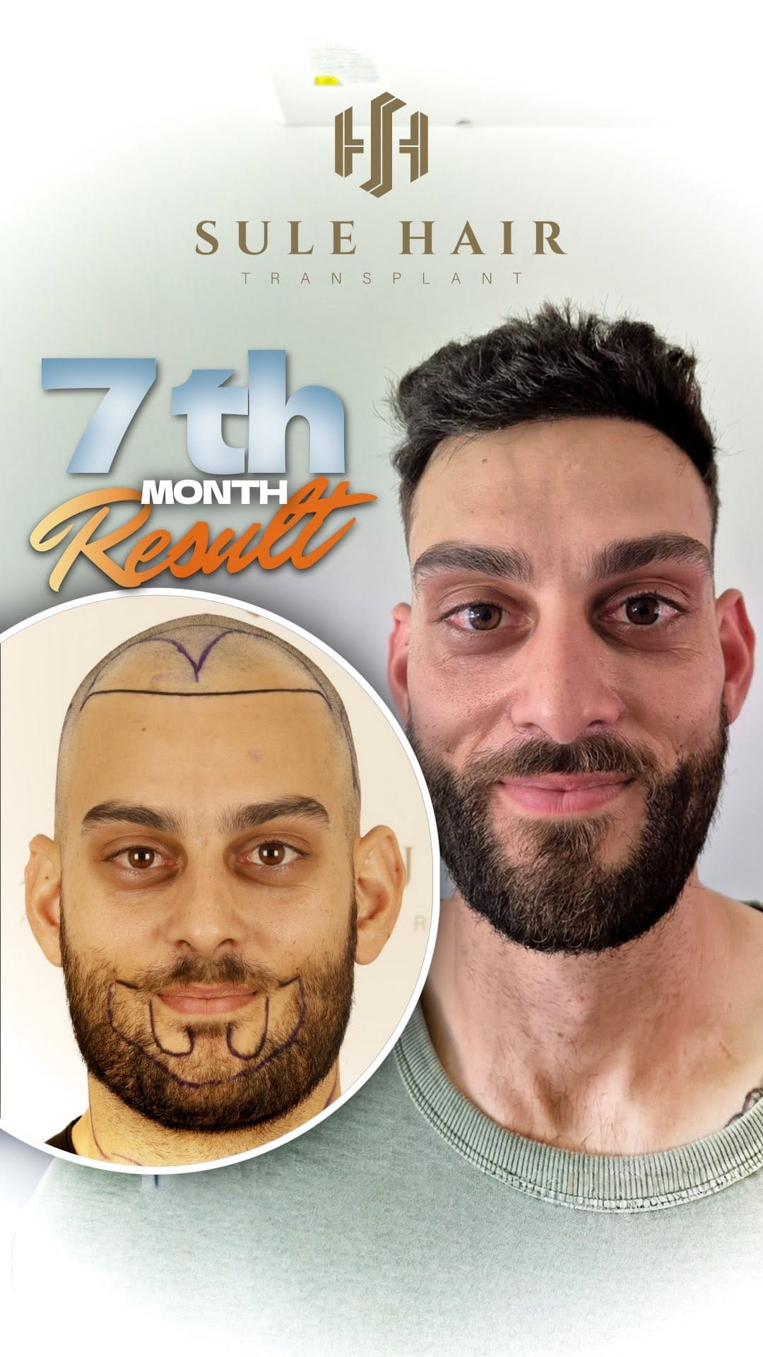 Post 5 by Sule Hair Transplant on Instagram (video)