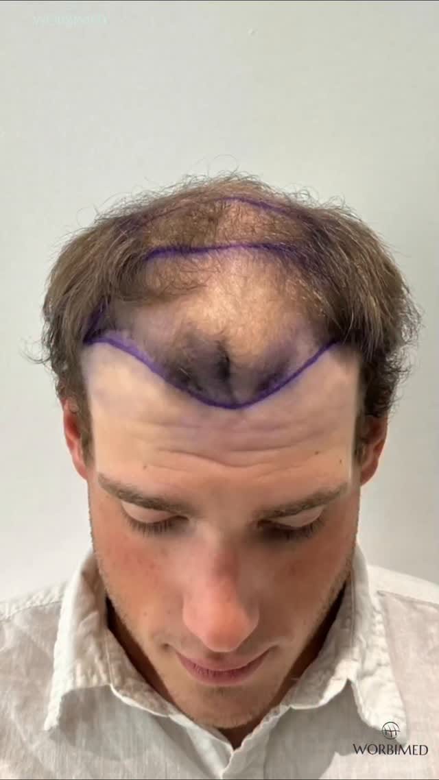 Post 4 by Hair Transplant in Turkey on Instagram (video)