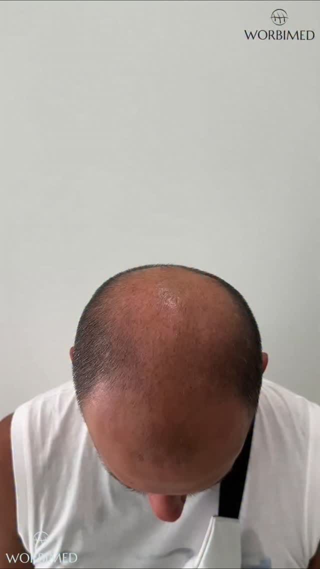 Post 7 by Hair Transplant in Turkey on Instagram (video)