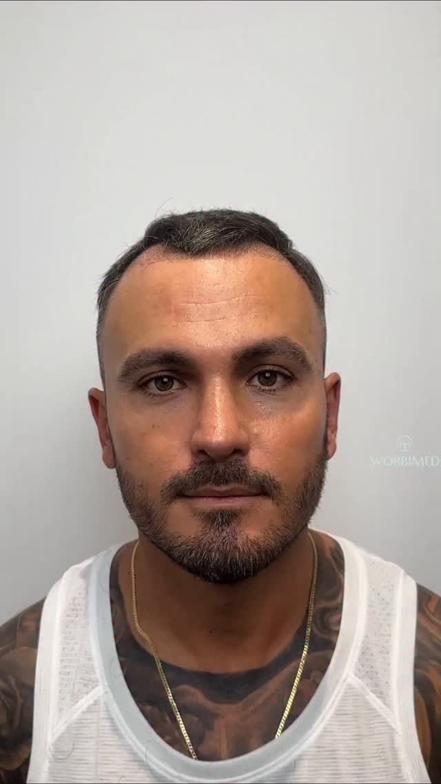 Post 5 by Hair Transplant in Turkey on Instagram (video)