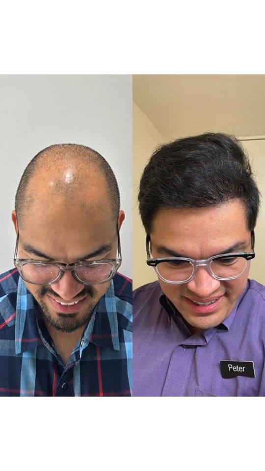 Post 10 by Hair Transplant in Turkey on Instagram (video)