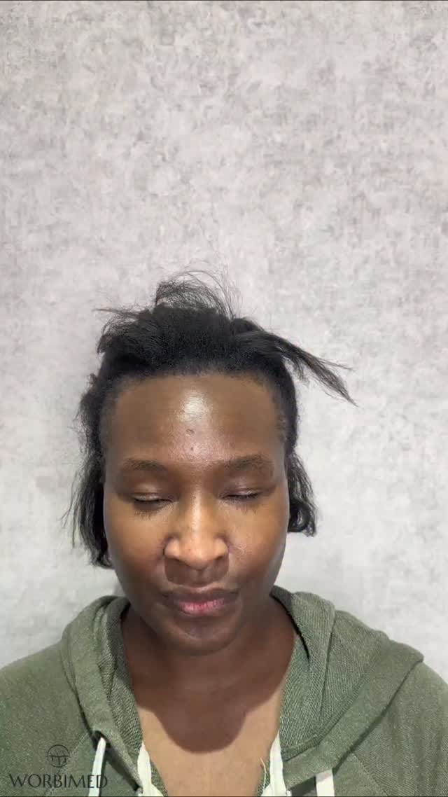 Post 8 by Hair Transplant in Turkey on Instagram (video)