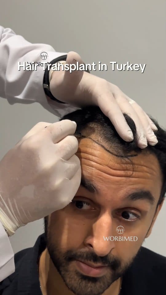 Post 6 by Hair Transplant in Turkey on Instagram (video)