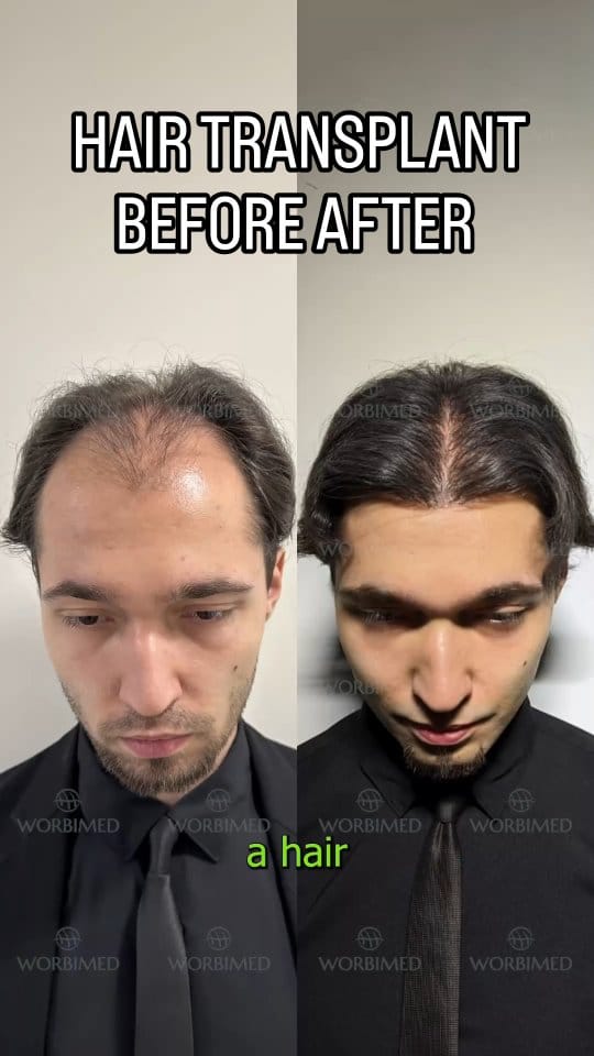 Post 3 by Hair Transplant in Turkey on Instagram (video)