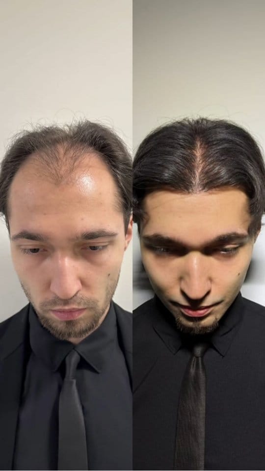 Post 9 by Hair Transplant in Turkey on Instagram (video)