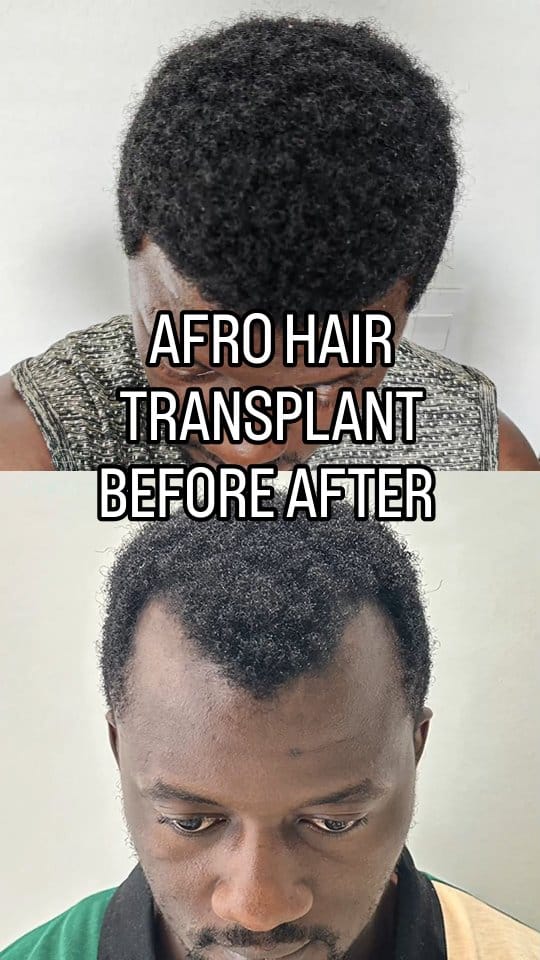 Post 1 by Hair Transplant in Turkey on Instagram (video)