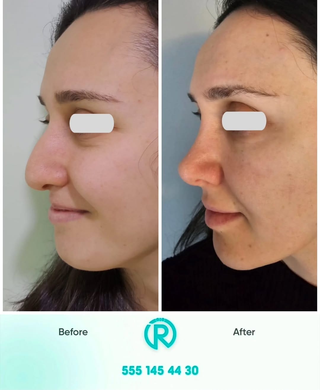 Post 3 by Op. Dr. Rahmi Özcelep on Instagram (carousel)