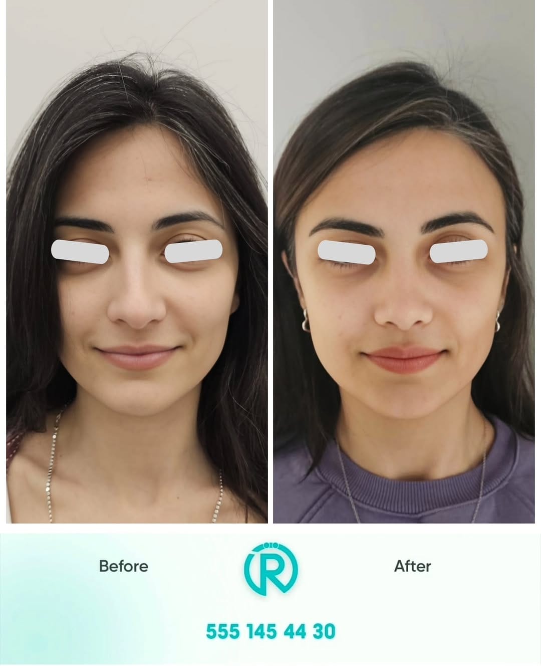 Post 2 by Op. Dr. Rahmi Özcelep on Instagram (carousel)