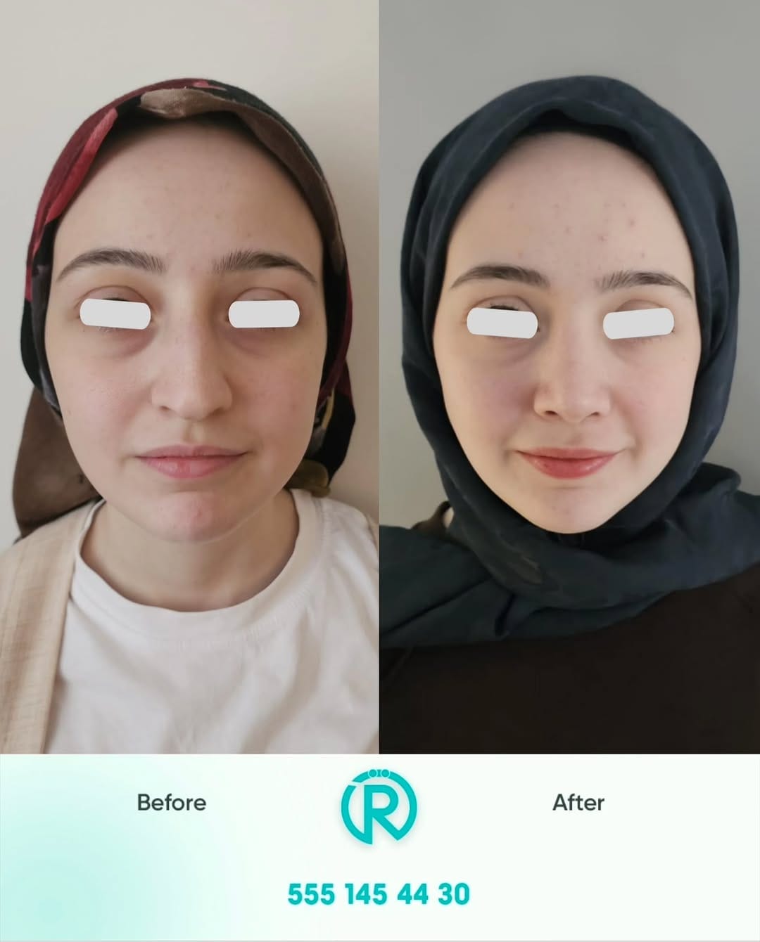 Post 5 by Op. Dr. Rahmi Özcelep on Instagram (carousel)