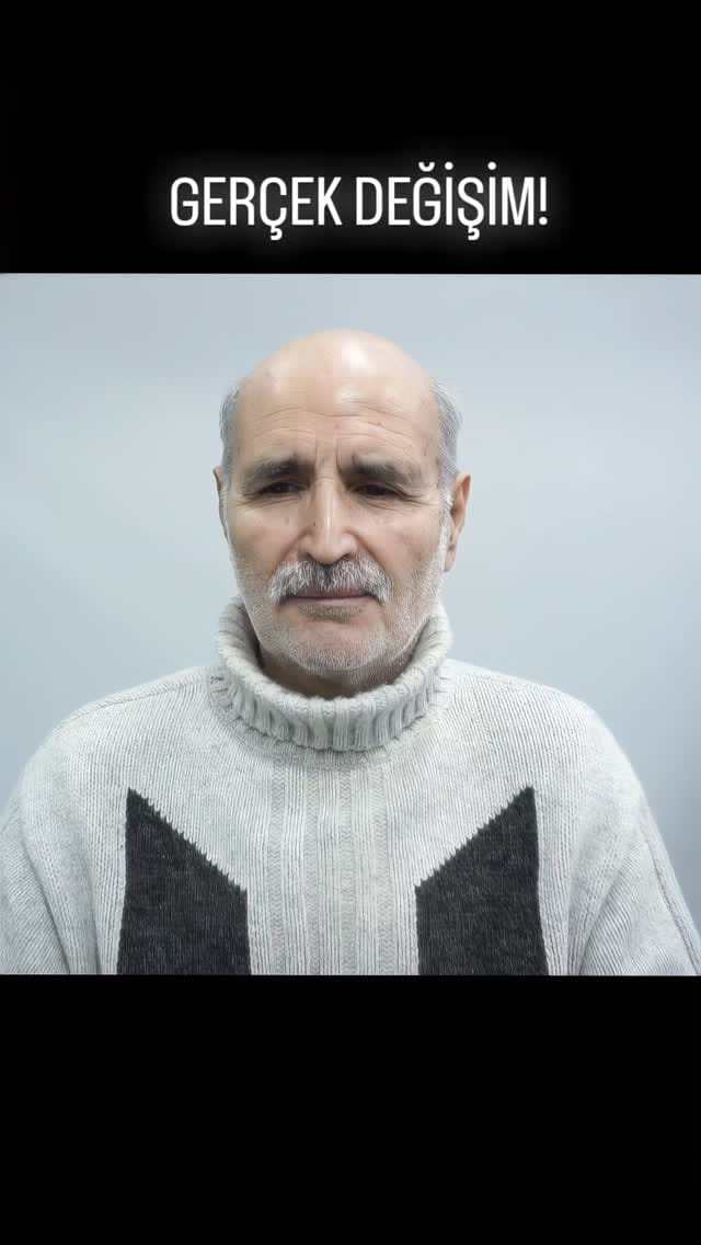 Post 4 by Protez Saç ve Saçlandırma Sistemleri on Instagram (video)