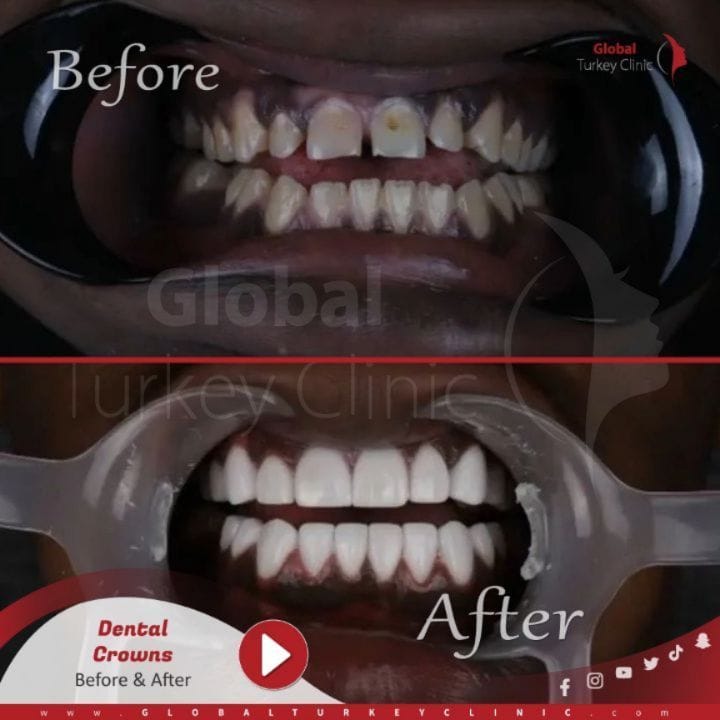 Post 3 by Global Turkey Clinic on Instagram (carousel)