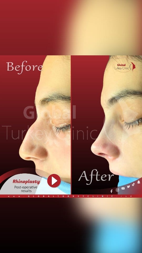Post 10 by Global Turkey Clinic on Instagram (video)