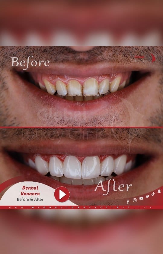 Post 6 by Global Turkey Clinic on Instagram (video)