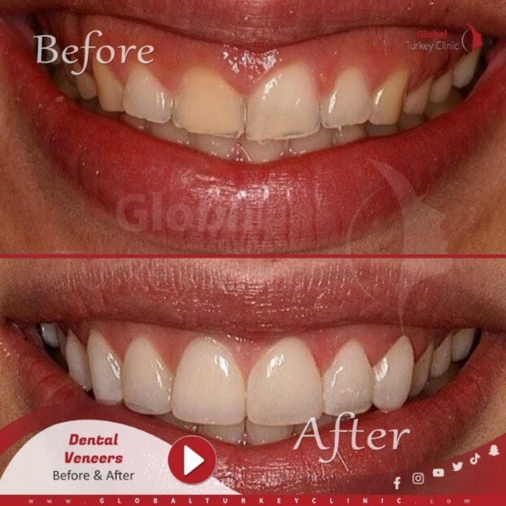 Post 9 by Global Turkey Clinic on Instagram (carousel)