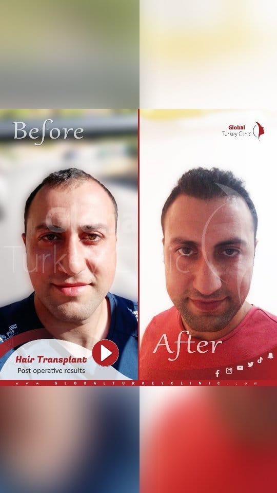 Post 2 by Global Turkey Clinic on Instagram (video)