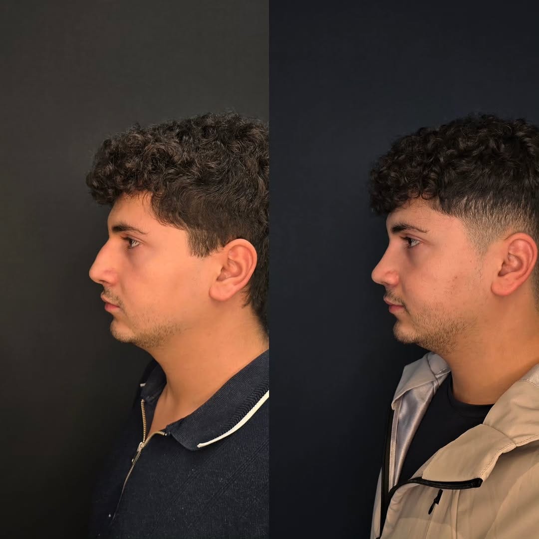 Post 2 by Op.Dr.Onur Gündoğan on Instagram (carousel)