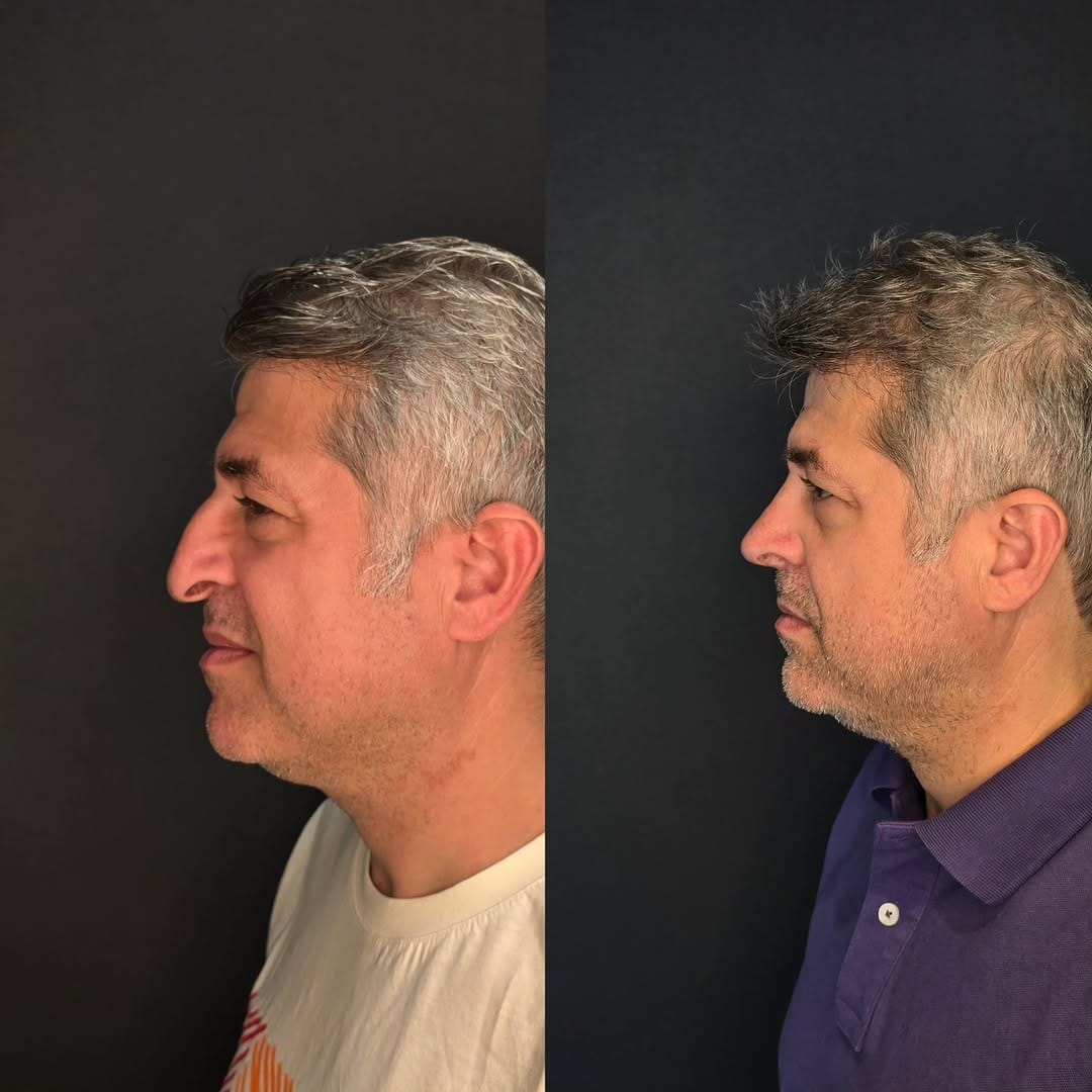 Post 7 by Op.Dr.Onur Gündoğan on Instagram (carousel)