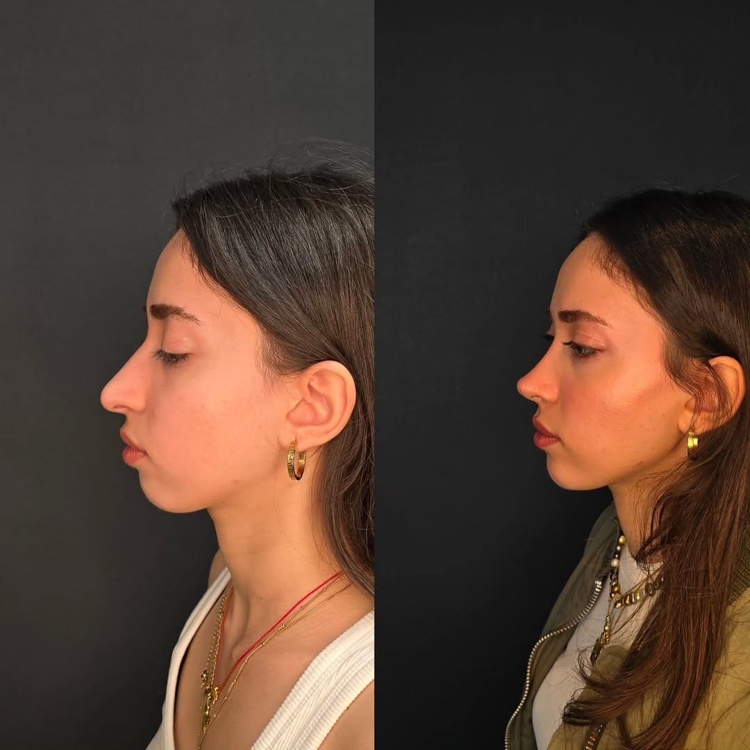 Post 5 by Op.Dr.Onur Gündoğan on Instagram (carousel)