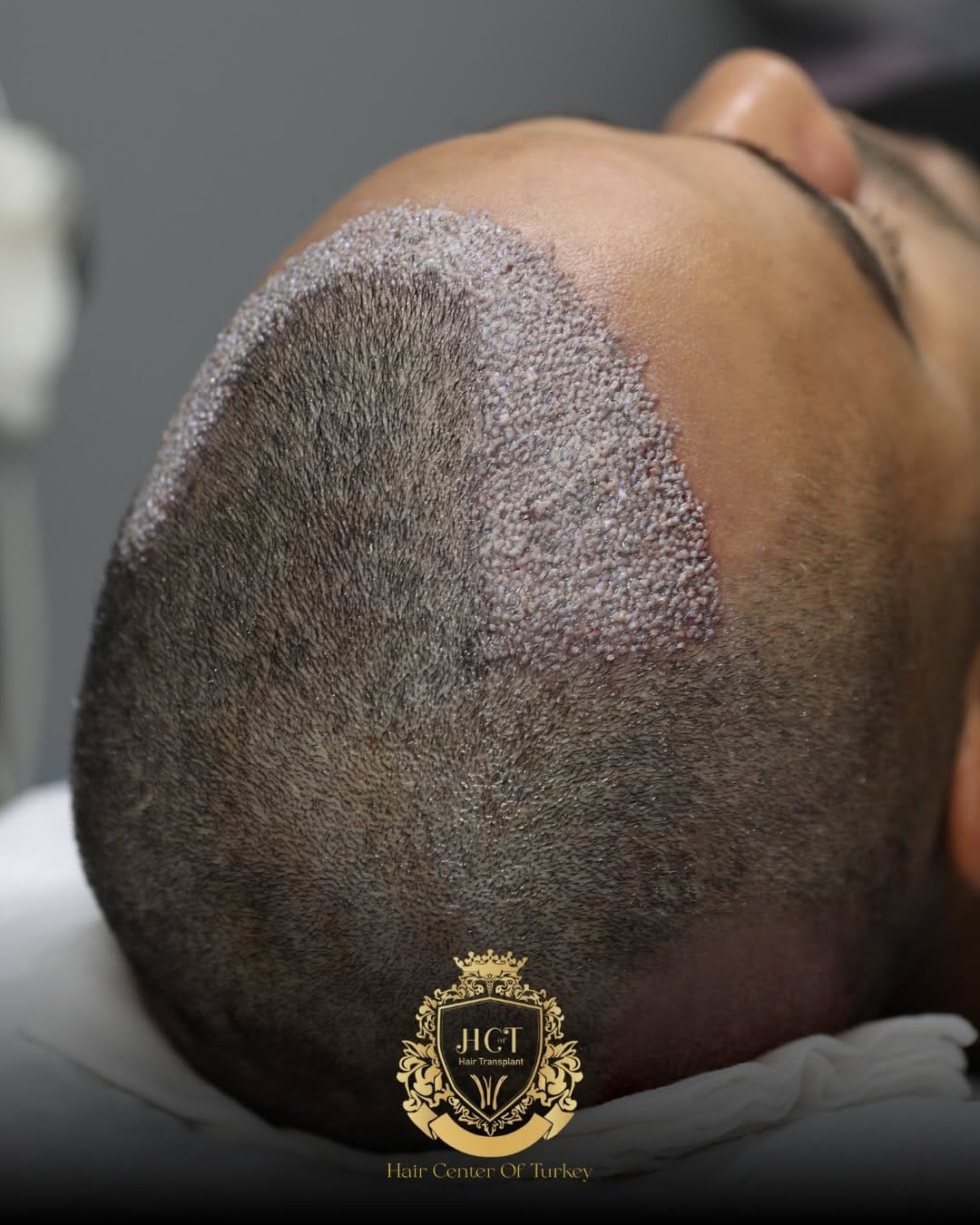 Post 1 by Hair Center Of Turkey | Hair Transplant on Instagram (carousel)