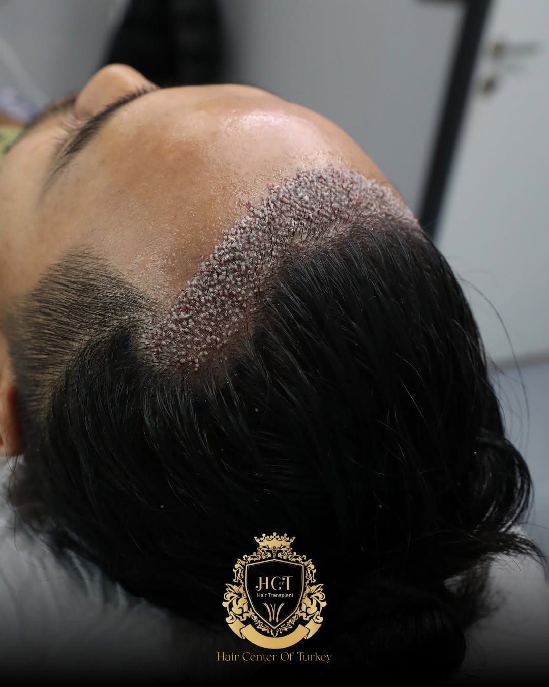 Post 4 by Hair Center Of Turkey | Hair Transplant on Instagram (image)
