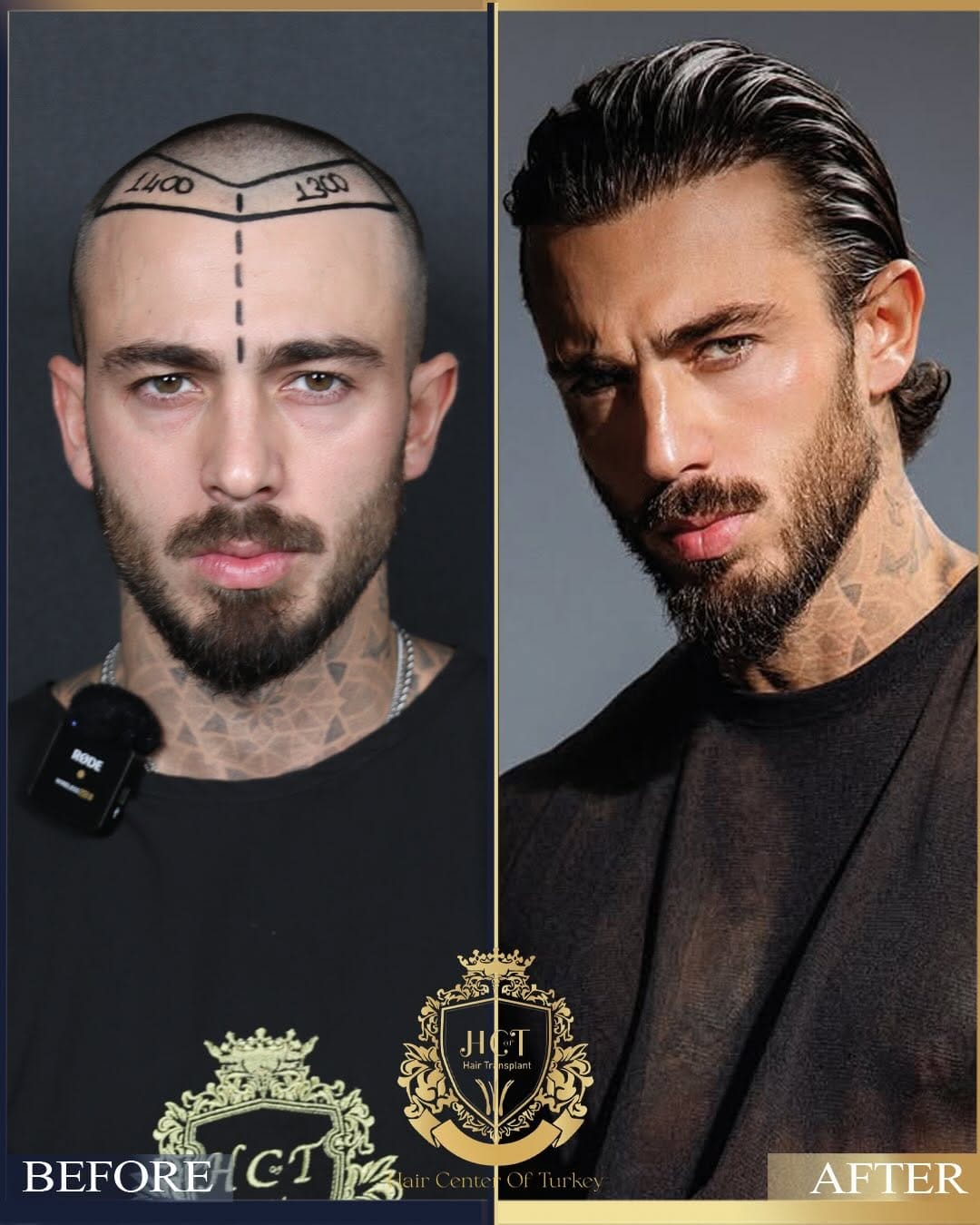 Post 3 by Hair Center Of Turkey | Hair Transplant on Instagram (carousel)