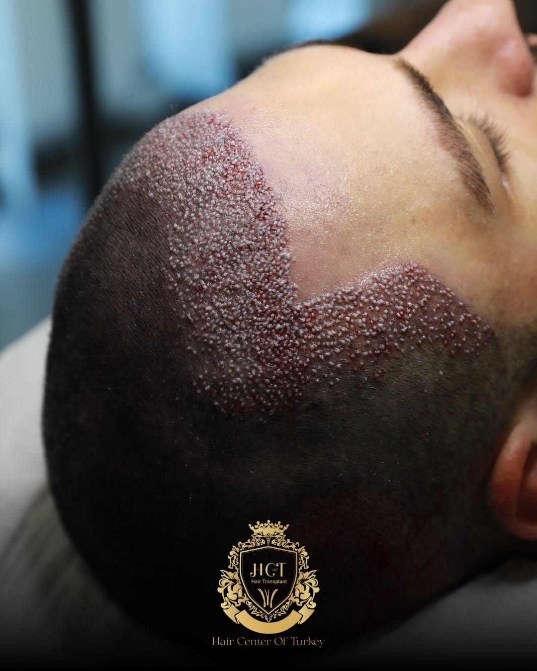 Post 7 by Hair Center Of Turkey | Hair Transplant on Instagram (carousel)