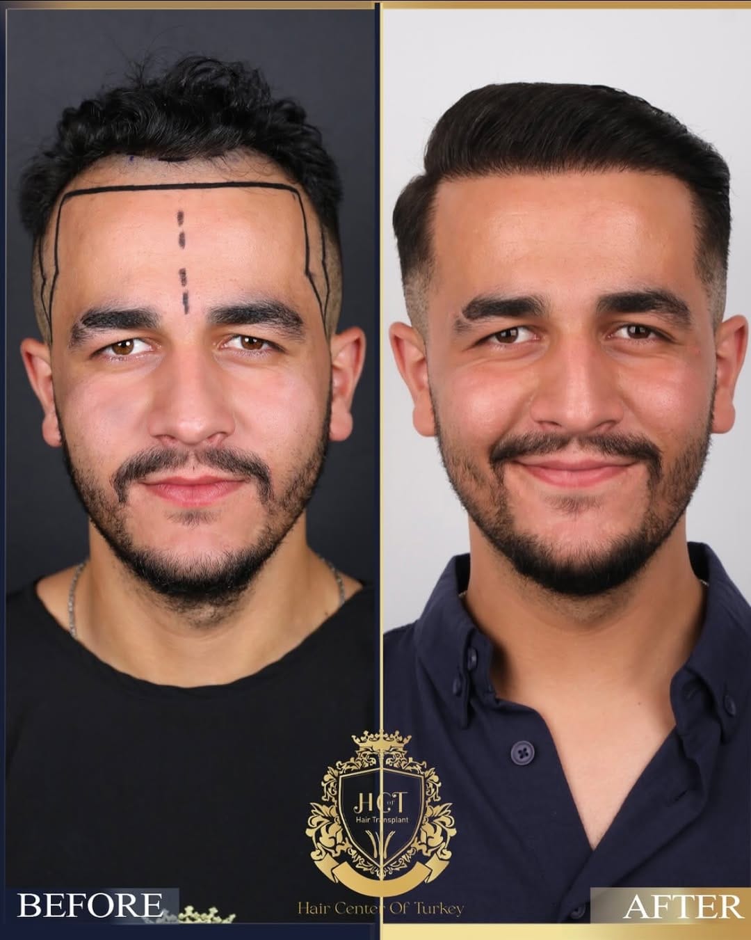 Post 6 by Hair Center Of Turkey | Hair Transplant on Instagram (carousel)