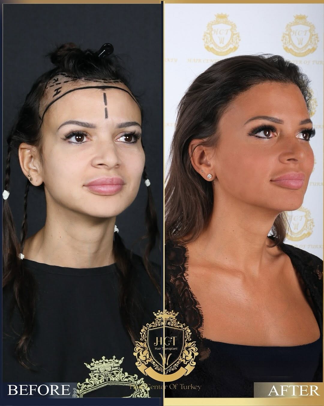 Post 10 by Hair Center Of Turkey | Hair Transplant on Instagram (carousel)