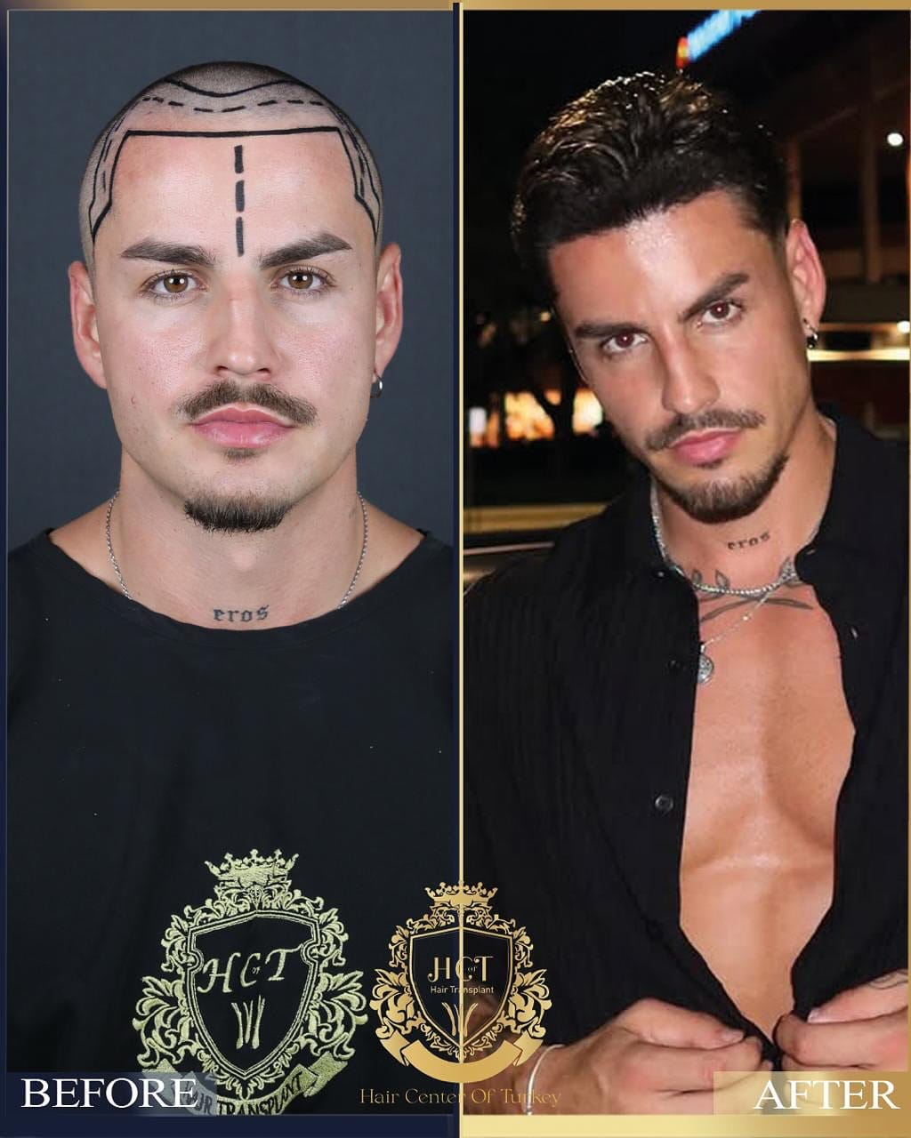 Post 9 by Hair Center Of Turkey | Hair Transplant on Instagram (carousel)
