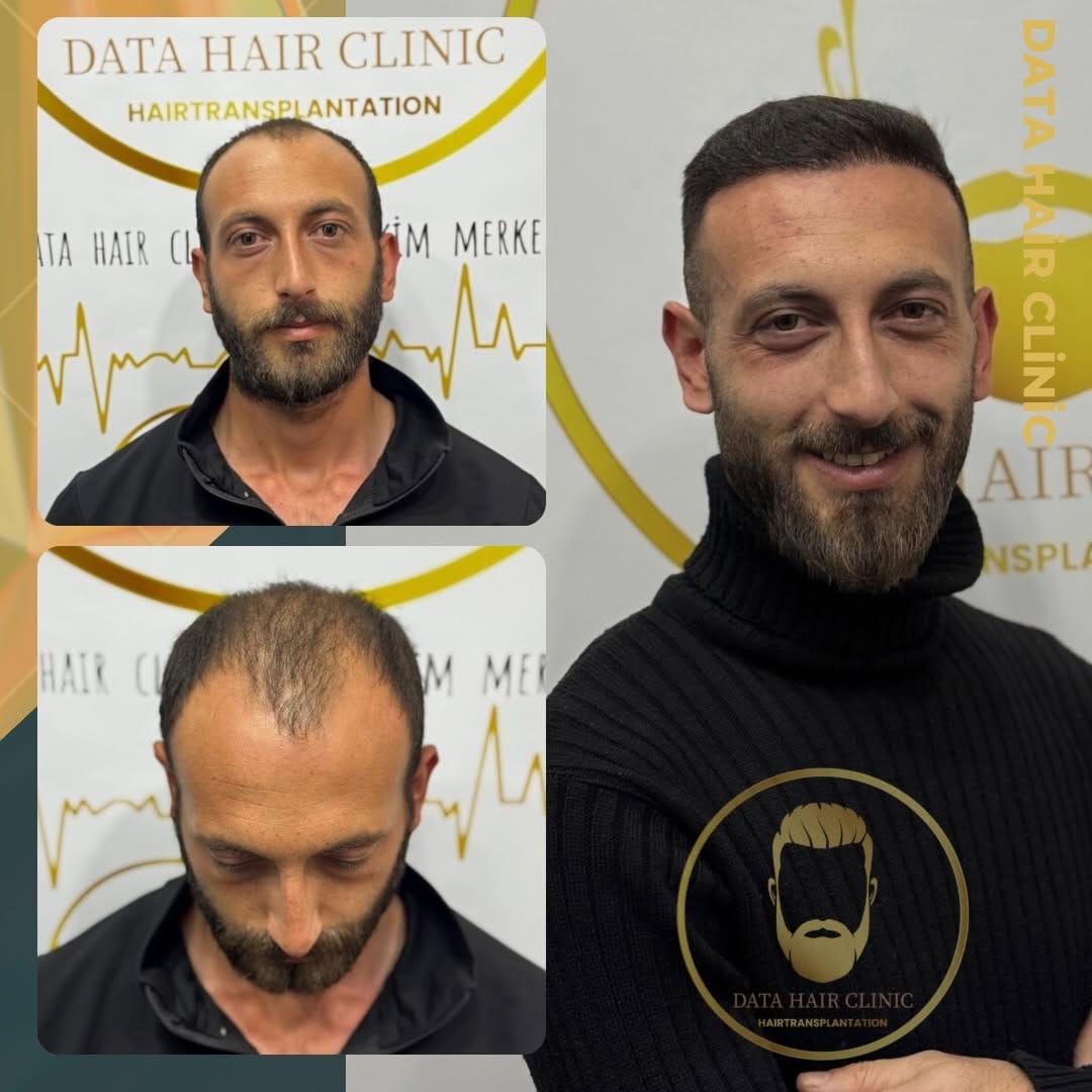 Post 1 by Saç Ekimi Ankara-Eyyüp TÜTÜNCÜ on Instagram (image)