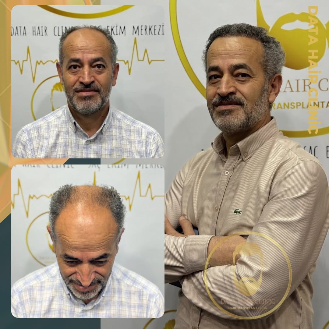 Post 4 by Saç Ekimi Ankara-Eyyüp TÜTÜNCÜ on Instagram (image)