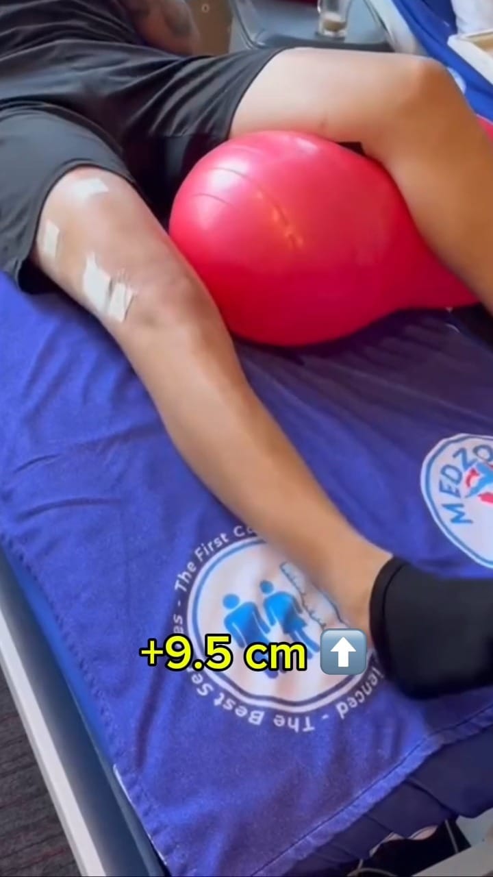 Post 7 by Limb Lengthening Surgery on Instagram (video)