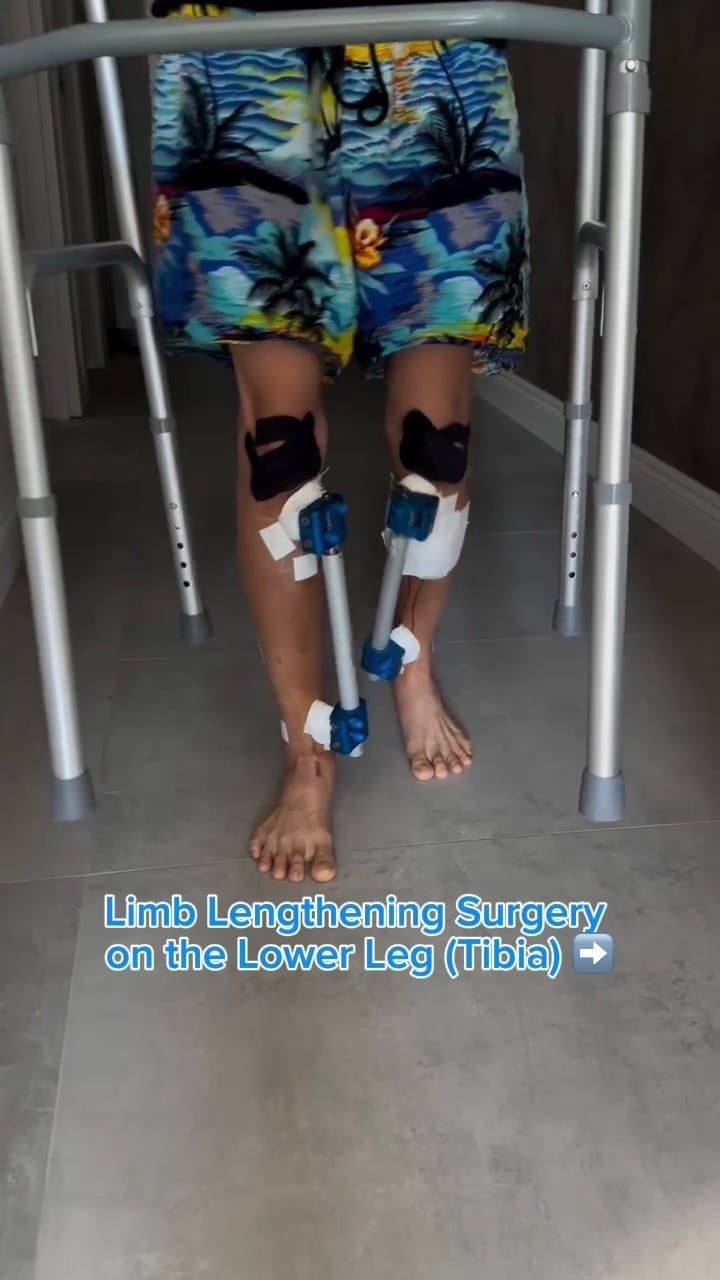 Post 8 by Limb Lengthening Surgery on Instagram (video)