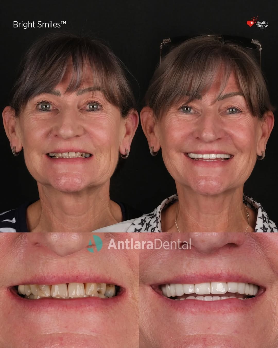 Post 1 by Antlara Dental Clinic on Instagram (carousel)