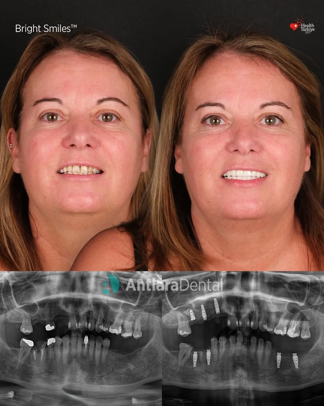 Post 7 by Antlara Dental Clinic on Instagram (carousel)